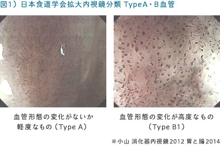 図1）日本食道学会拡大内視鏡分類 TypeA・B血管